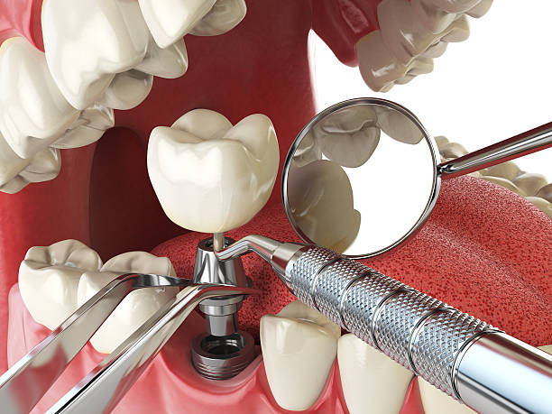 Best Emergency Tooth Extraction in North Kansas City, MO